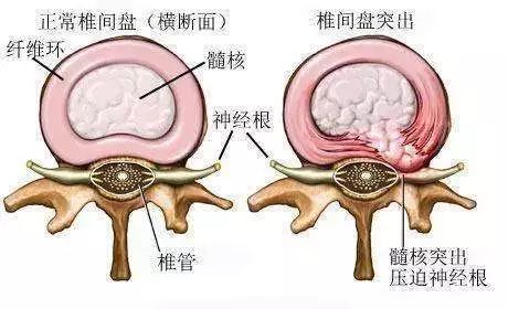 腰椎间盘突出最新疗法，探索前沿技术与治疗希望