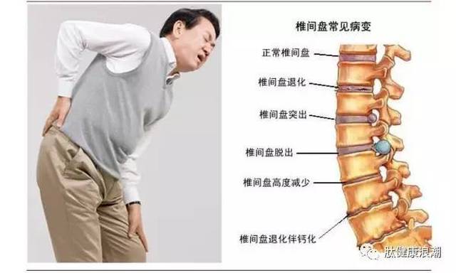 最新腰突疗法揭秘，前沿技术助力患者重返健康之路